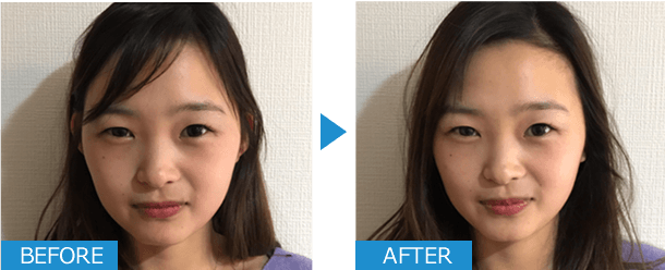 美容鍼ビフォーアフター写真