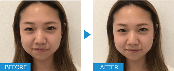 美容鍼ビフォーアフター写真