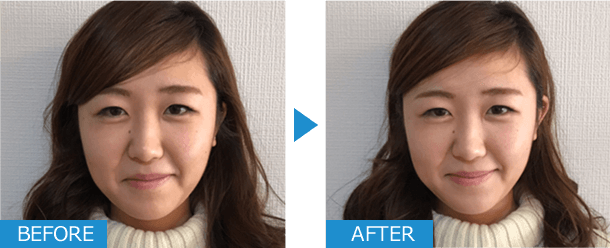美容鍼ビフォーアフター写真